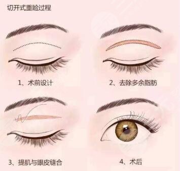 李桂珍醫(yī)生做雙眼皮價格參考