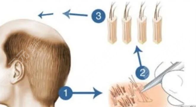 北京大學深圳醫(yī)院植發(fā)