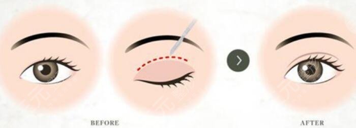 雙眼皮手術