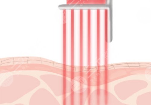 浙大二院點陣激光多少錢一次