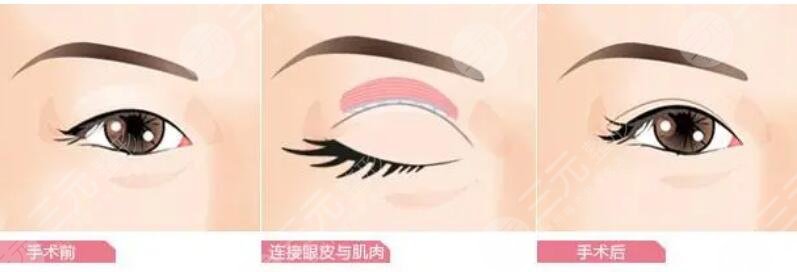 雙眼皮手術(shù)