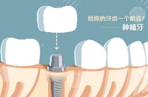牙齒種植