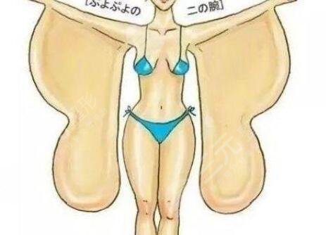 蝴蝶袖吸脂