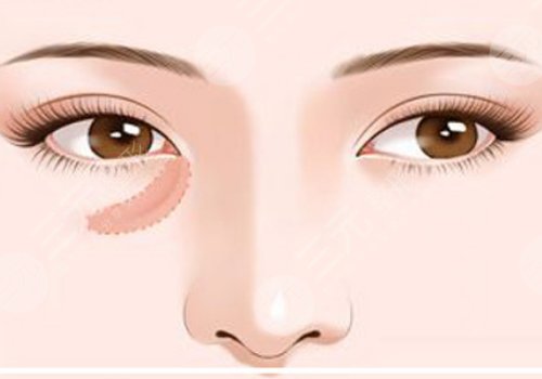 上海九院脂肪填充淚溝多少錢