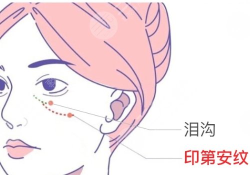 上海九院脂肪填充淚溝多少錢