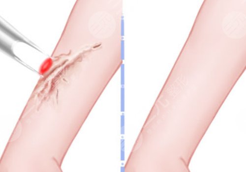 章一新疤痕怎么樣