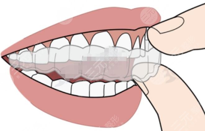 隱形牙齒矯正
