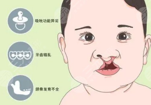 章建林做唇腭裂好嗎