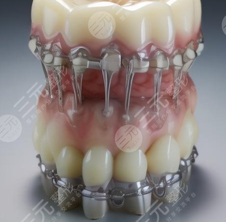 牙齒種植