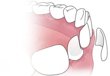 瓷貼面修復(fù)