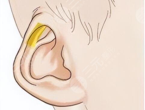 耳再造