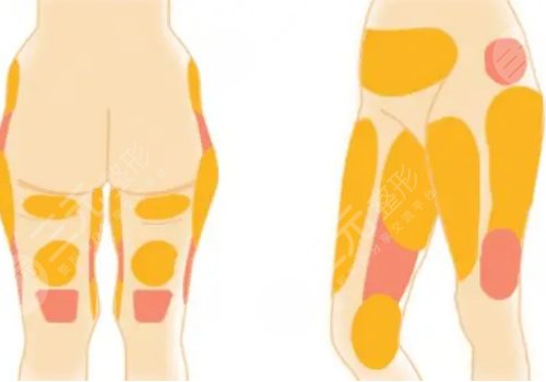 北京禾美嘉吸脂怎么樣