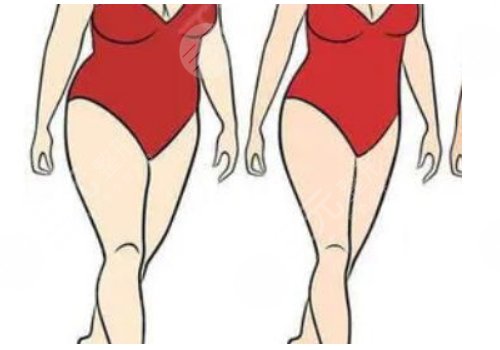 北京禾美嘉吸脂怎么樣