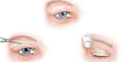 雙眼皮修復