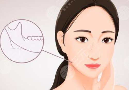 北京圣嘉新做磨骨手術(shù)多少錢