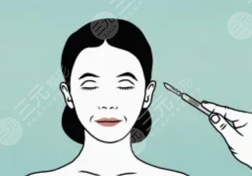 王志堅(jiān)醫(yī)生小拉皮提升做的怎么樣