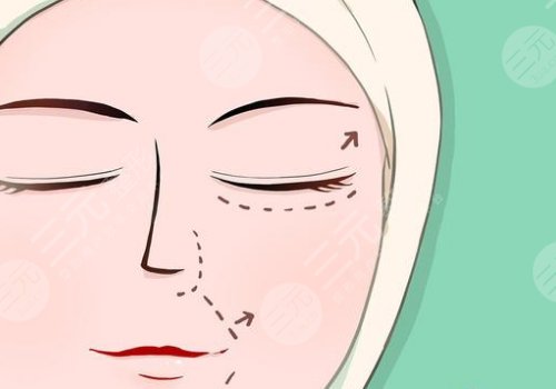 王志堅(jiān)醫(yī)生小拉皮提升做的怎么樣