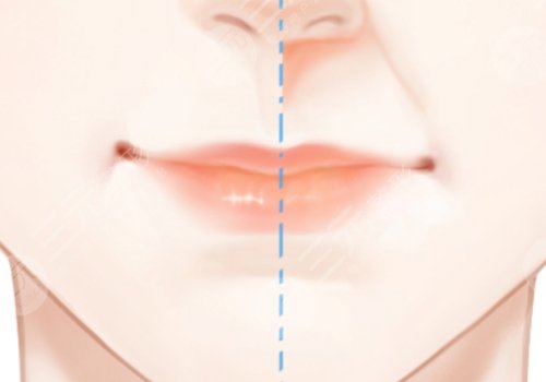 李勁良醫(yī)生鼻基底是用膨體嗎