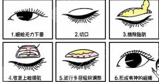 雙眼皮手術(shù)