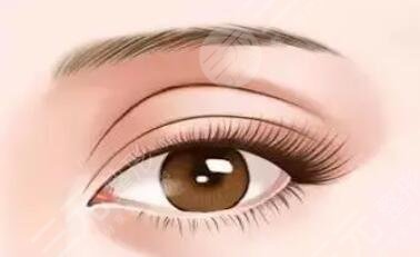 雙眼皮修復(fù)