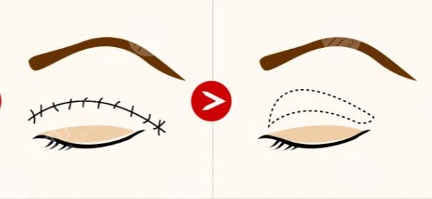 雙眼皮修復(fù)