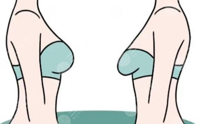 乳房下垂矯正