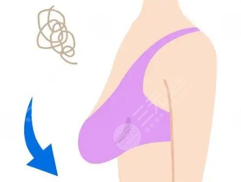 乳房下垂矯正