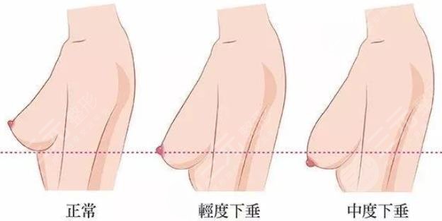 乳房懸垂