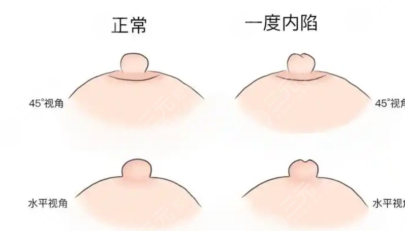 乳頭內(nèi)陷