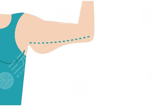 王曾思做吸脂手術(shù)怎么樣