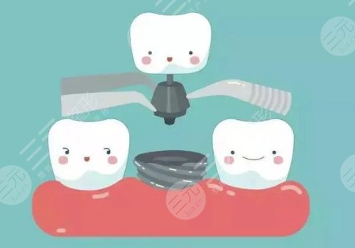 良鄉(xiāng)醫(yī)院種牙多少錢