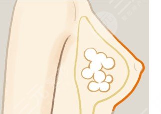 王馳醫(yī)生隆胸怎么樣?