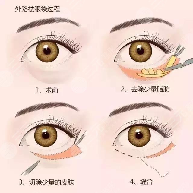 空軍總醫(yī)院做眼袋哪位大夫好