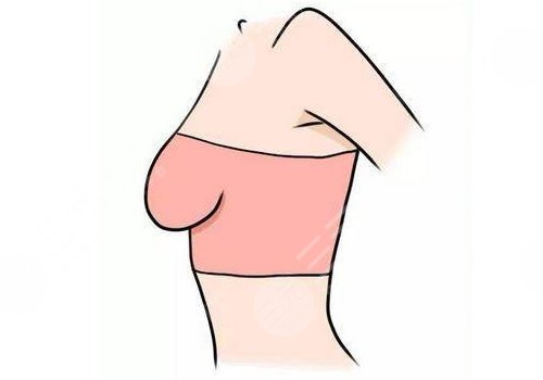 成都軍大梁軍醫(yī)生做乳腺下垂手術(shù)怎么樣