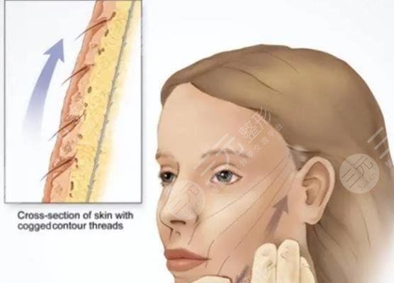 面部筋膜懸吊術