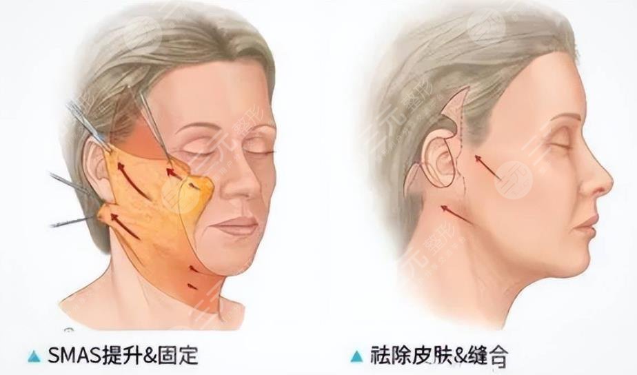 面部筋膜懸吊術=