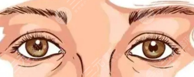雙眼皮