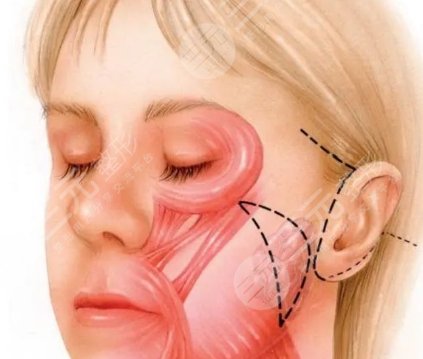 耳前韌帶提升