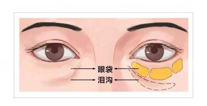 膠原蛋白VS玻尿酸