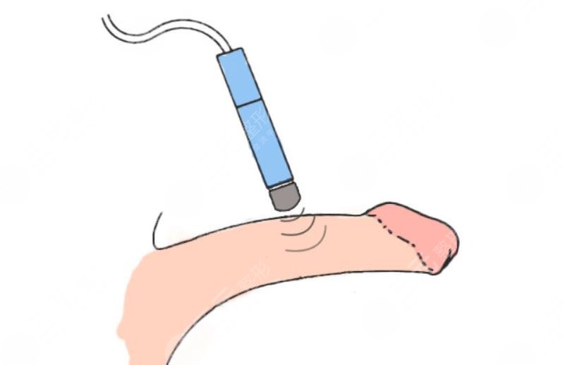 上海陰莖延長(zhǎng)手術(shù)多少錢(qián)