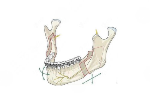新華醫(yī)院正頜手術(shù)價(jià)格