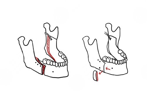 新華醫(yī)院正頜手術(shù)價(jià)格