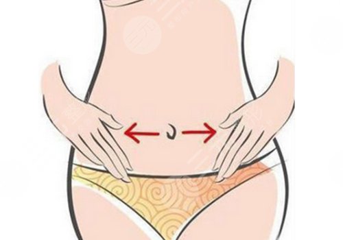 上海曹衛(wèi)剛做腹壁成形術(shù)