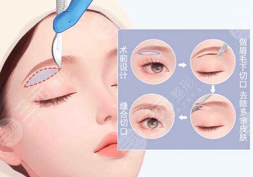 北京青藍整形醫(yī)院提眉