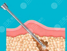 超聲溶脂和光纖溶脂哪個(gè)安全？風(fēng)險(xiǎn)點(diǎn)各有側(cè)重，避坑關(guān)鍵看適配