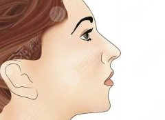 膨體墊下巴多久能恢復(fù)自然？真人時(shí)間線(xiàn)+價(jià)目表，不繞彎子