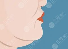 雙下巴黃金微雕恢復(fù)期，術(shù)后30天細(xì)節(jié)清單，直接照抄就行