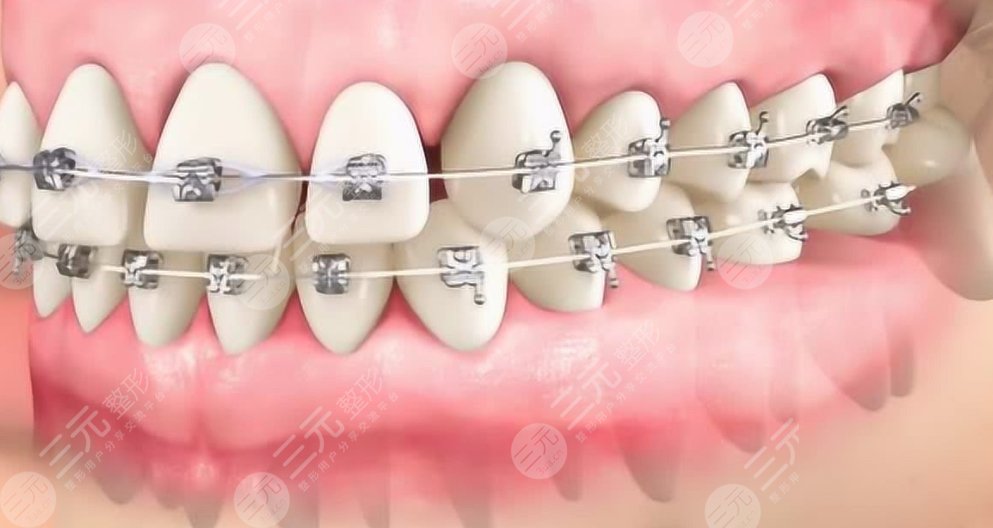 牙齒矯正